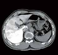 There are no lesions in other parts of the liver, indicating that there has been no tumor spread.