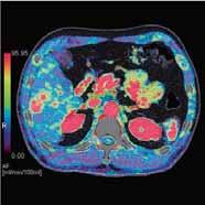 He underwent transarterial chemoembolization (TACE), and liver perfusion CT was performed to assess the effectiveness of TACE treatment.
