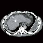 CASE 5 HCC treatment assessment (continued) HCC treatment assessment Patient History This 52-year-old man has a history of alcoholic liver damage and hepatocellular carcinoma (HCC) in segments 4 and