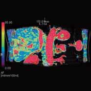 A liver perfusion CT study was performed to assess the patient s response to TACE and the advisability of further TACE treatment.