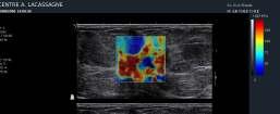 Supersonic Shear Imaging: Breast Imaging BIRADS 5 at mammo & US.