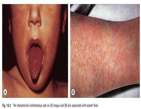 Scarlet fever. If the GAS causing pharyngitis produces exotoxins mentioned, the URTI will be associated with a diffuse erythematous rash of the skin and mucous membranes.