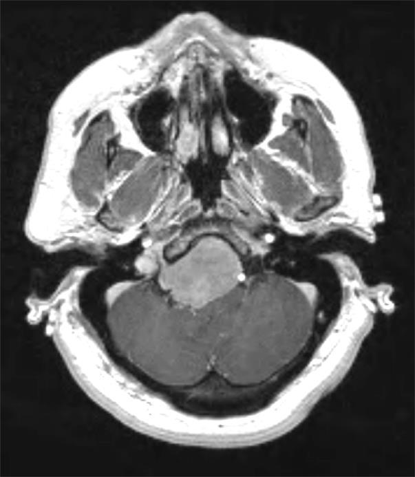 Case Illustration #4 MRI of the brain showed a large,