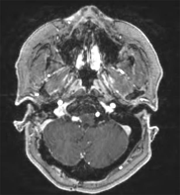 retrosigmoid craniotomy, C1 laminectomy, and partial