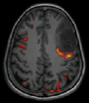 Case Illustration #3 45 year old right-handed woman presented with transient expressive aphasia