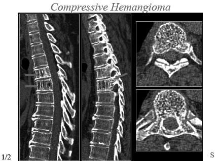 symptomatic (neurologic deficit, pain ) F > M Features of compressive/aggressive hemangiomas: Location between T3 and T9 Entire vertebral body involved +/-