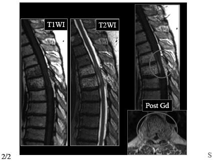 Well-defined vertical striations or honeycombed appearance CT: Stippled, polka dot appearance (course trabeculae) MR (typical): T1WI: Hyperintense (due to fat)