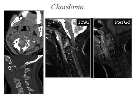 tumors arising from notochordal remnants Sacrococcygeal 50%; Clivus 35%-40%; Vertebral body