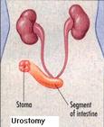 1. Ileal conduit A short piece of the small intestine is