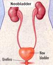 3. Neobladder A urinary reservoir (neobladder) is made from a piece of small intestine.