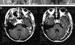 these tumors to achieve an enormous size before manifesting neurologic