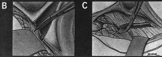 the sigmoid sinus toward the superior petrosal