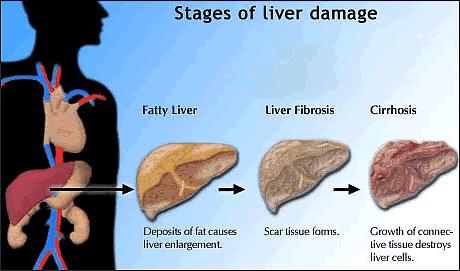 CIRRHOSIS What is Cirrhosis: Cirrhosis is the end stages of a liver disease.