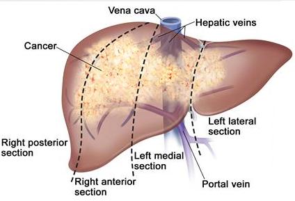Liver Cancers: There is an increased risk of developing liver cancers if you have cirrhosis.