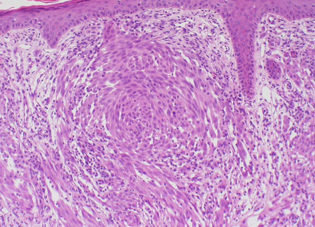 radial growth phase Unlike excisional biopsy there is