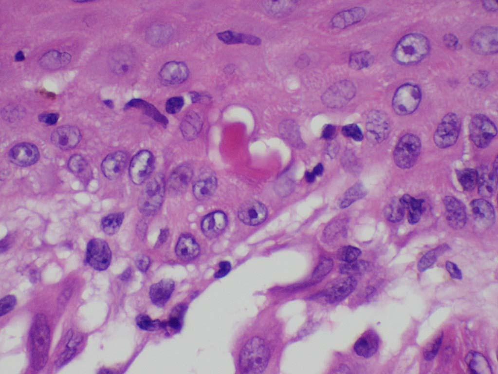 Case 2 Biopsy of a non-pigmented nodular lesion in a