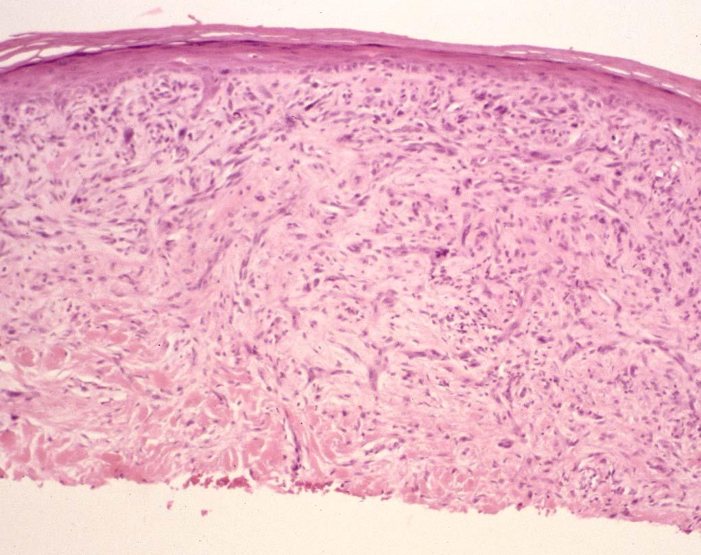 5.) Melanoma misdiagnosed as Spitz nevus When this occurs some referral centers perform sentinel lymph node biopsy In one