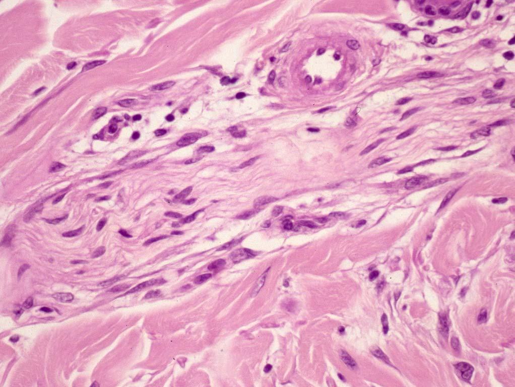 melanomas are associated with lentigo maligna or atypical lentiginous proliferations 37 38 Case 3 A 40 year old had a