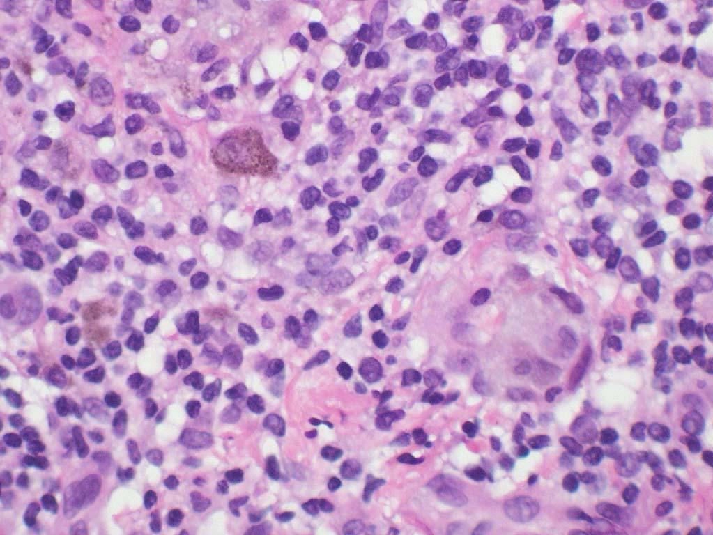 melanocytic lesions under high power even if they appear to be typical nevi under low power Look for mitoses (frequent and/or deep), cytologic atypia, coalescence of nests, melanin in deep tumor