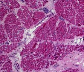 Muscle involvement in systemic sclerosis Histopathology: Muscle