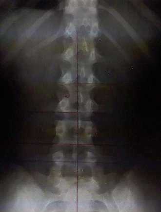 Case Studies Patient: 15 Year Old Gymnastics Student Symptom: Low Back Pain Diagnosis: Chronic