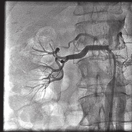 Methods We retrospectively analyzed consecutive patients from our institution who underwent percutaneous treatment of RA- ISR with SES placement (Cypher) at the discretion of the primary operator