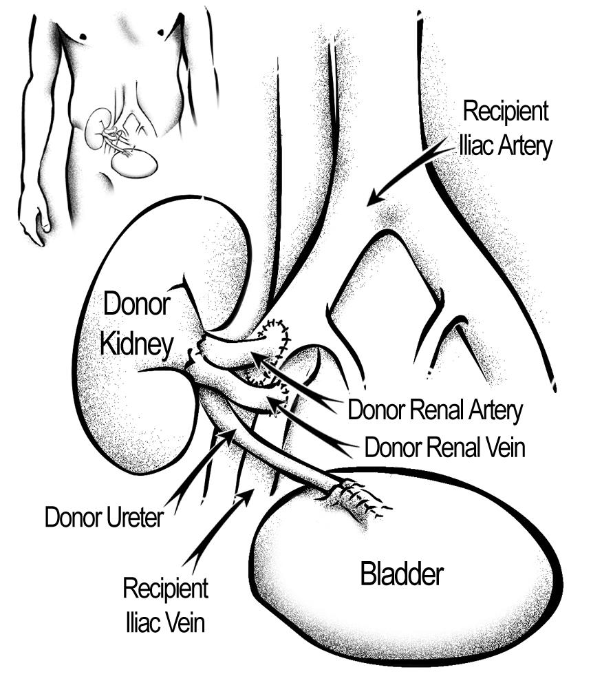 Surgery Page 9-6 3. After blood circulation to the kidney is established, the surgeon will connect the donor ureter into your bladder.