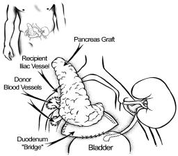 Surgery Page 9-8 a) Bladder drainage is a method where the surgeon uses a section of the donor duodenum (intestine) to bridge and collect the