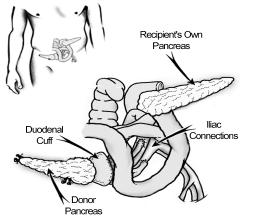 Page 9-9 Surgery b) Enteric drainage (or bowel drained) is another method to drain the pancreas secretions.
