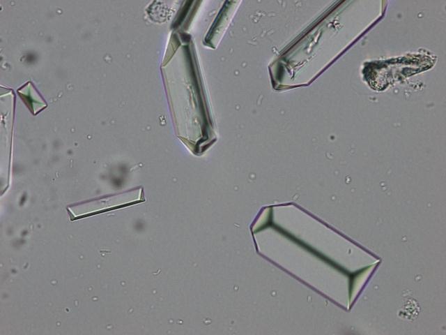 Alkaline urine crystals (usually non-pathologic): Triple phosphate MICROSCOPIC EXAMINATION Calcium carbonate Calcium phosphate Ammonium biurate