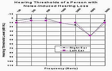 An normal audiogram An audiogram showing the classic dip in hearing performance PTS is characterised by a loss of consonant discrimination.