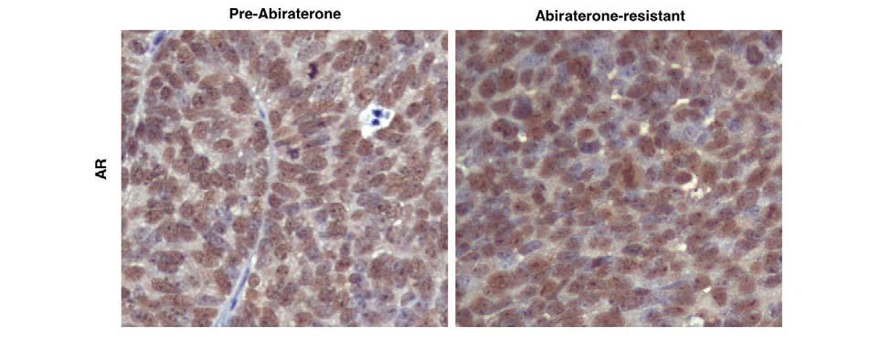 Figure S14. AR regained nuclear staining in the abiraterone-resistant VCaP xenogarft tumor.