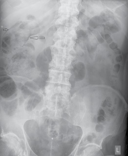 Culleton et al. 199 with a CT of the abdomen or an abdominal X-ray is recommended.