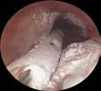 Slide 31 Indications Barrett's esophagus with high-grade dysplasia and persistent low-grade dysplasia Early stage esophageal cancer not amenable to standard therapies including surgery, chemotherapy,