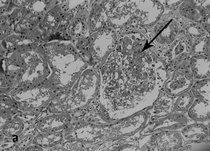 Microscopic view of the kidney biopsy showing the characteristic feature of PAN. Endocapillary proliferation with a segment of fibrinoid necrosis(hematoxylin and eosin staining, x 200).