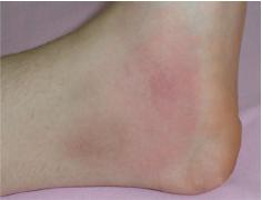 Signs and symptoms of FMF Fever a[acks for 1-3 days ArthriMs a[acks Rash that can