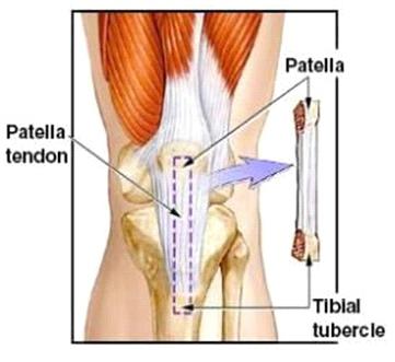 ACL Surgery Informed Consent 5 Surgical Choices Patellar tendon autograft.