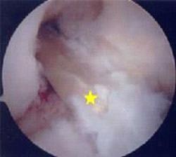 ACL Surgery Informed Consent 7 Arthroscopic view of ACL graft [yellow star] in position.