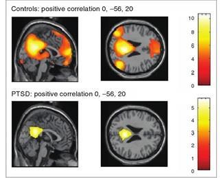 Overactive Alarm Chronic Activation of the threat response system in childhood causes changes in the connectivity of neural systems