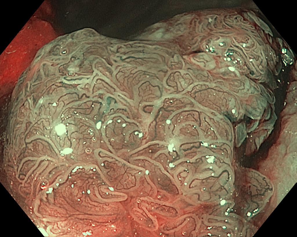 NPV) [6]. Therefore, optical diagnosis of colorectal polyps according to NICE criteria has been proposed as a tool to guide therapeutic decisions and surveillance strategies in clinical practice.