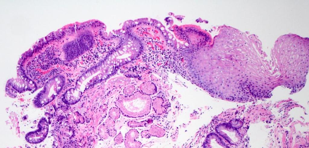 Distal esophagus biopsy Barrett s mucosa?
