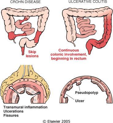 Crohn s disease vs.