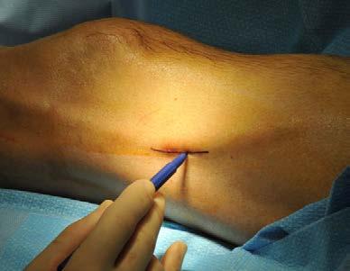 Wound issues - incisions and ulcers