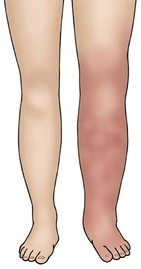 Signs and symptoms of VTE DVT - Symptoms can include swelling, redness/ discolouration, warmth and tenderness/pain that may be worse when standing or walking.