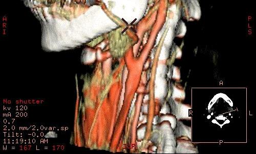 Herniated Disc Spur / Arthritis http://www.