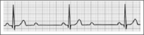AV Block (High Grade) Unconducted P waves High Grade Conduction ratio of 3:1 or worse Guarded prognosis Risk