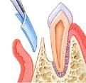 regeneration Mild periodontitis