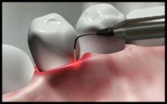 TREATMENTS FOR PERIODONTAL DEFECTS TREATMENTS FOR PERIODONTAL DEFECTS Guided Tissue Regeneration Similar to osseous surgery but may not be resective Trying to regenerate: bone, PDL, cementum Can use