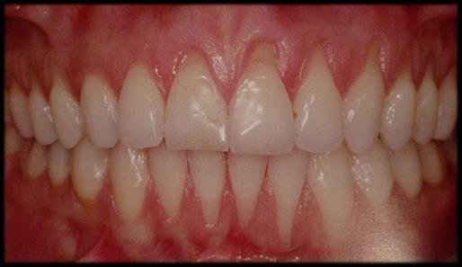 Orthodontic Periodontal Patient Depending on