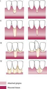 treat gingival recession?